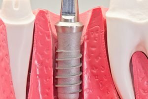 como se realiza un implante dental