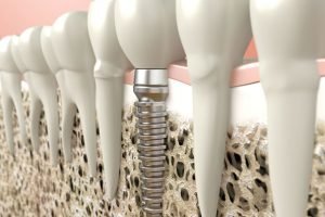 implante dental con tornillos de acero